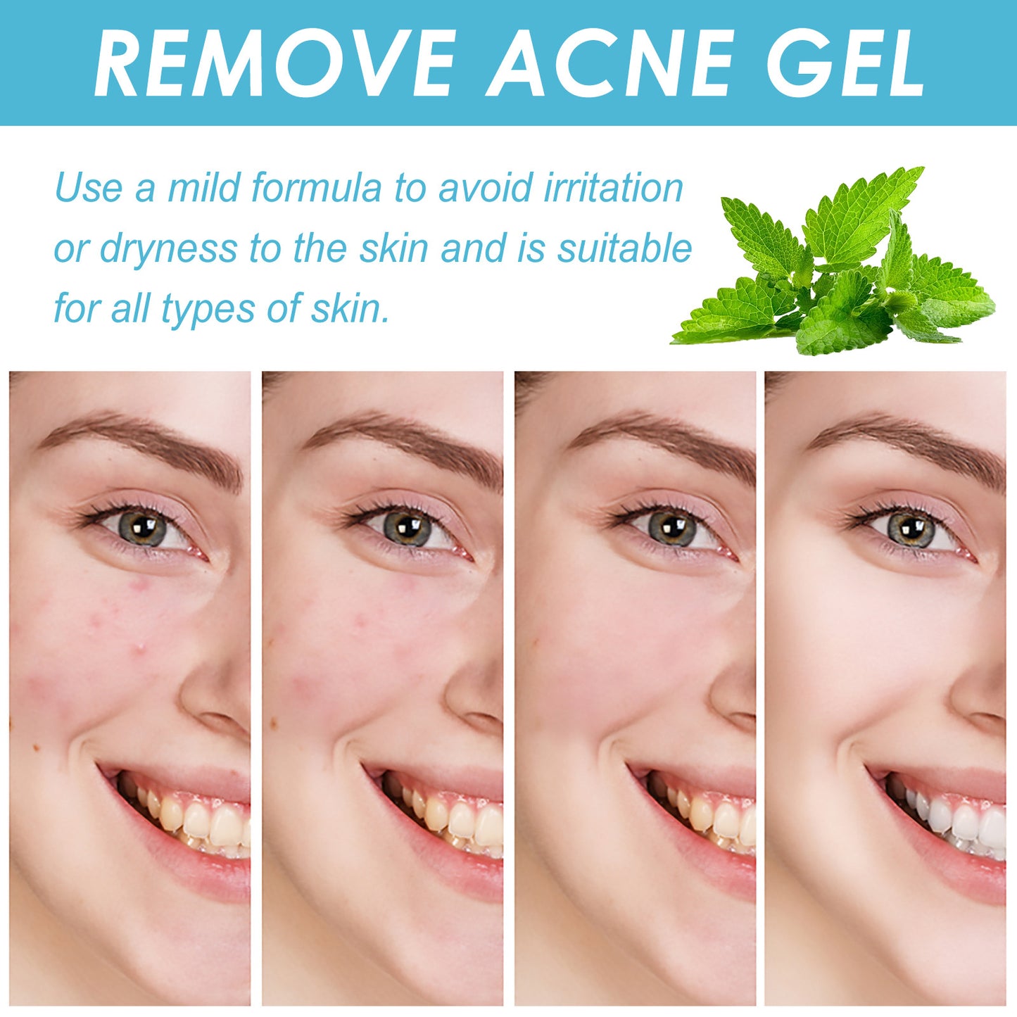 OUHOE Remove Acne Gel.