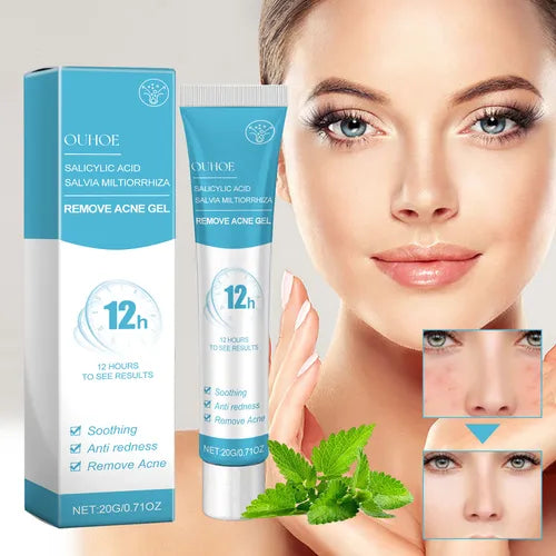 OUHOE Remove Acne Gel.